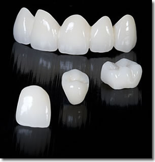 dental crown frisco tx